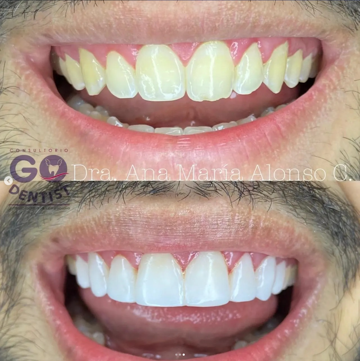 Comparación de sonrisa antes y después de un tratamiento estético dental