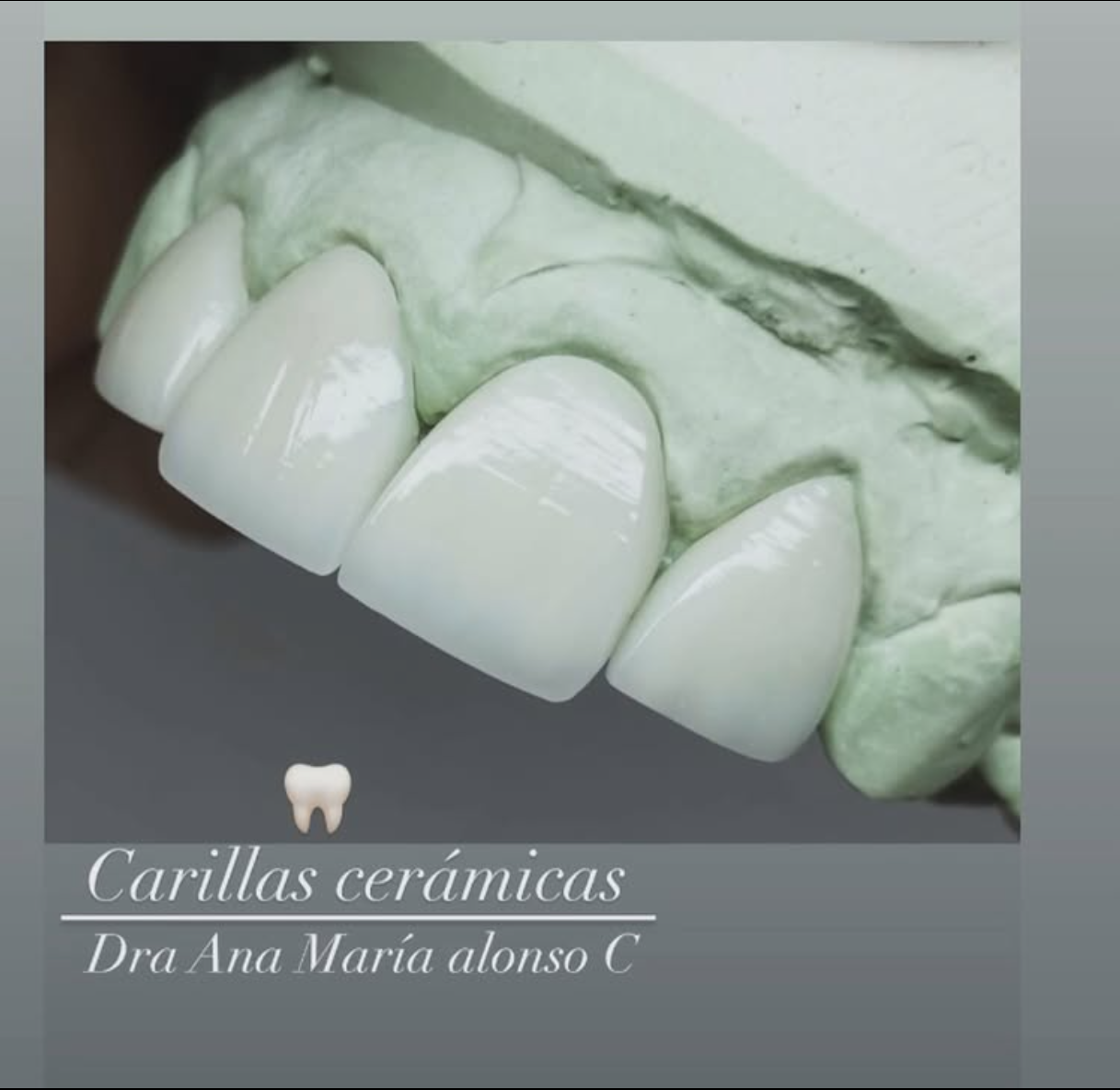 Modelo dental con carillas cerámicas en primer plano sobre superficie de trabajo clínica