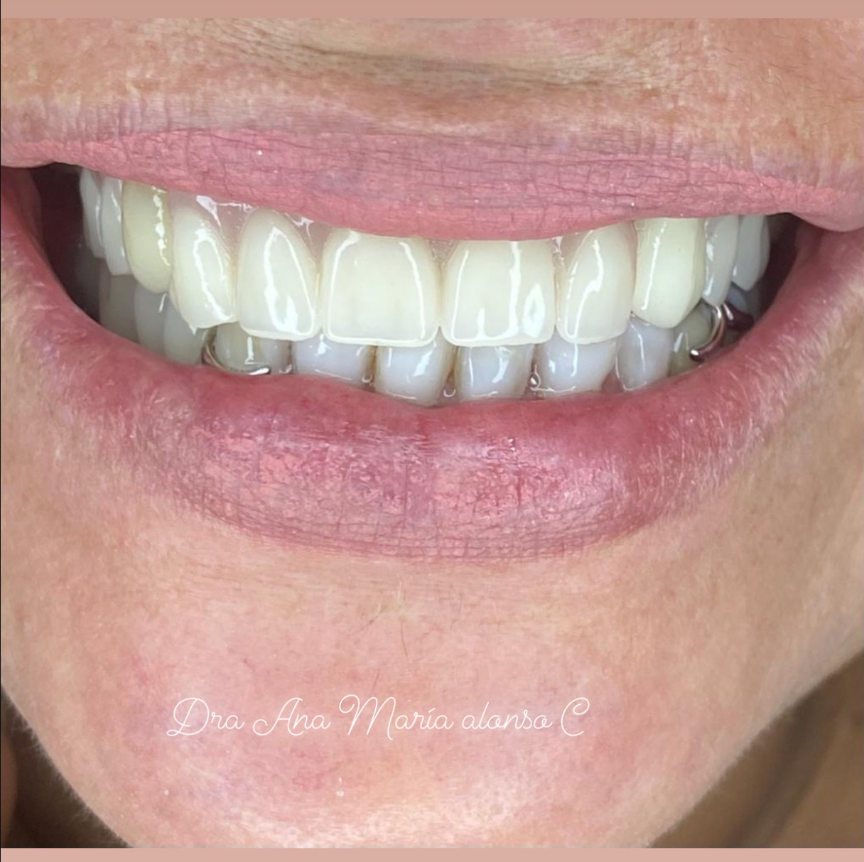 Sonrisa restaurada después de tratamiento estético dental