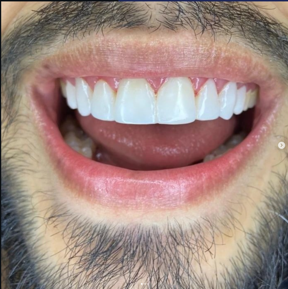 Primer plano de una sonrisa restaurada con acabado natural después de tratamiento estético dental